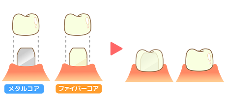 メタルコアとファイバーコアのイメージ画像
