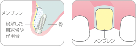 GBR法のイメージ
