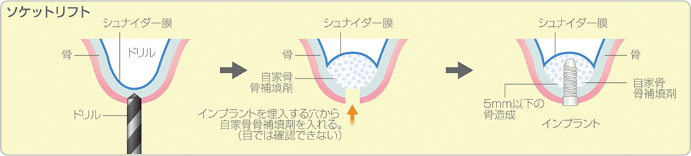 ソケットリフトのイメージ