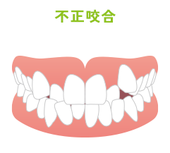 不正咬合