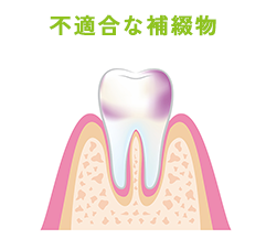 不適合な補綴物 