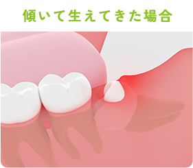 傾いて生えてきた場合