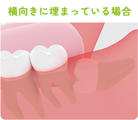 横向きに埋まっている場合
